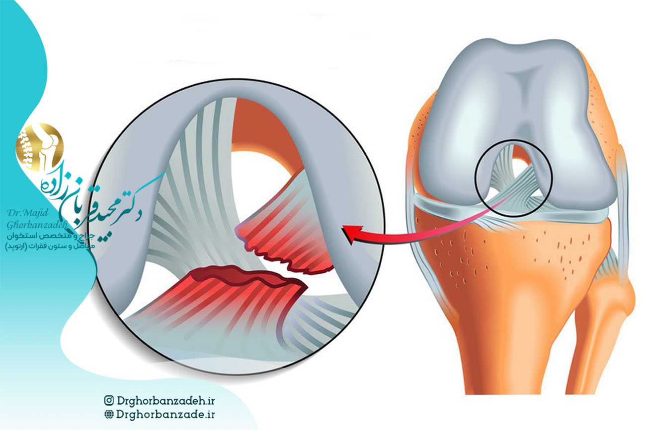 پارگی رباط صلیبی زانو چیست؟