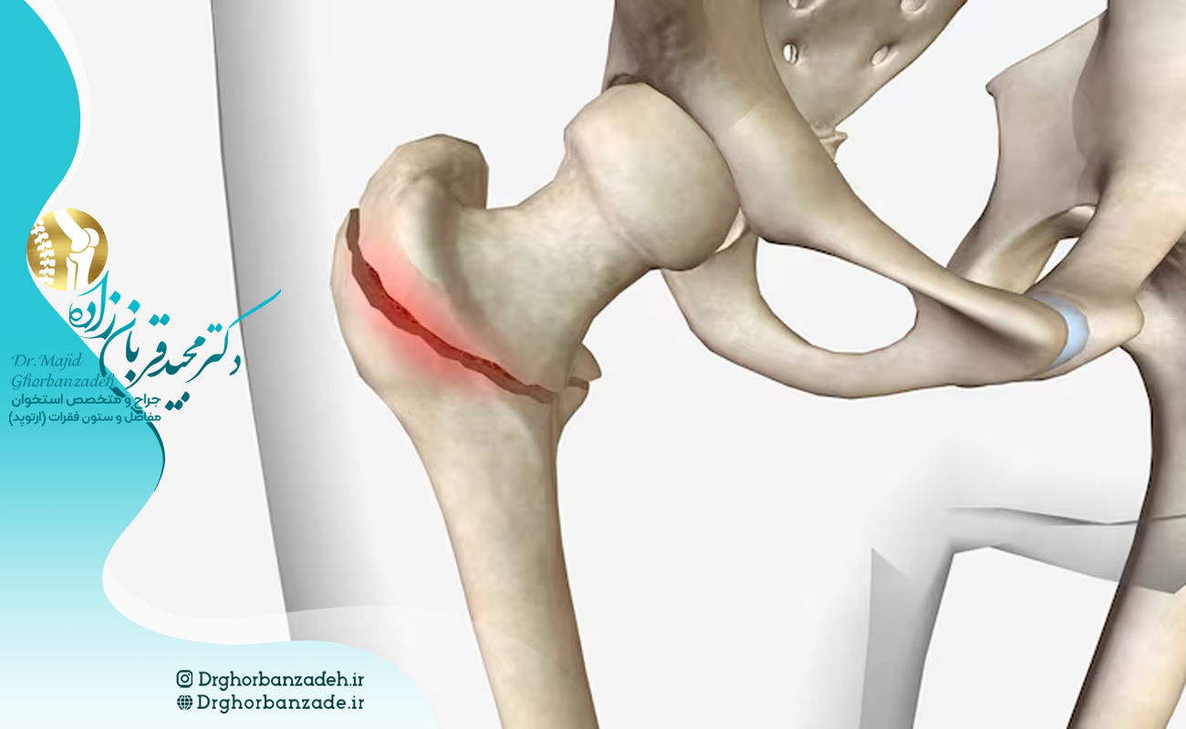 تشخیص شکستگی لگن