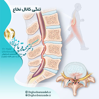 تنگی-کانال-نخاع تنگی-کانال-نخاع