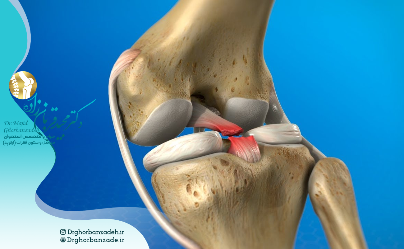 آیا رباط صلیبی بازسازی میشود؟