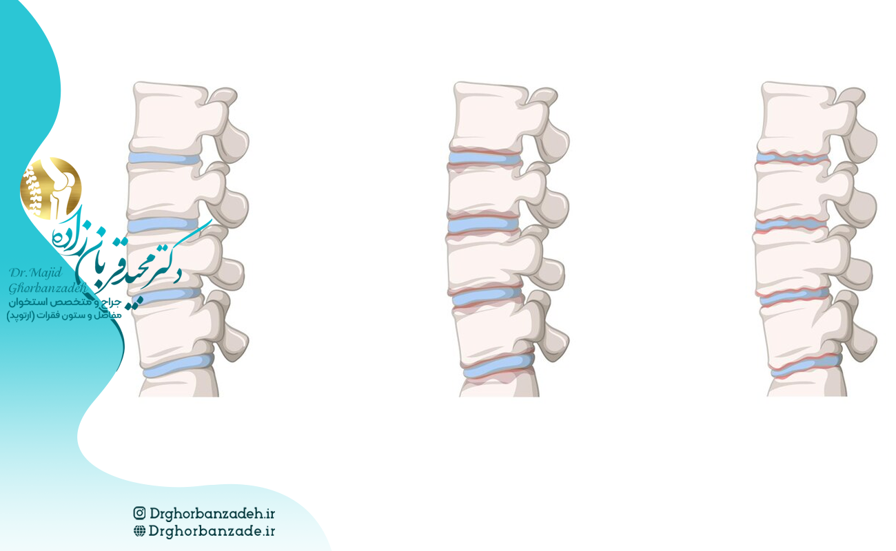 تشخیص تنگی کانال نخاعی