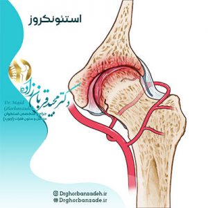 استئونکروز یا نکروز آوسکولار چیست ؟
