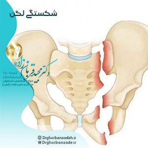 شکستگی لگن