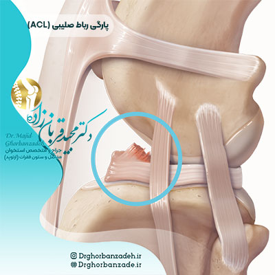 پارگی رباط صلیبی قدامی (ACL)
