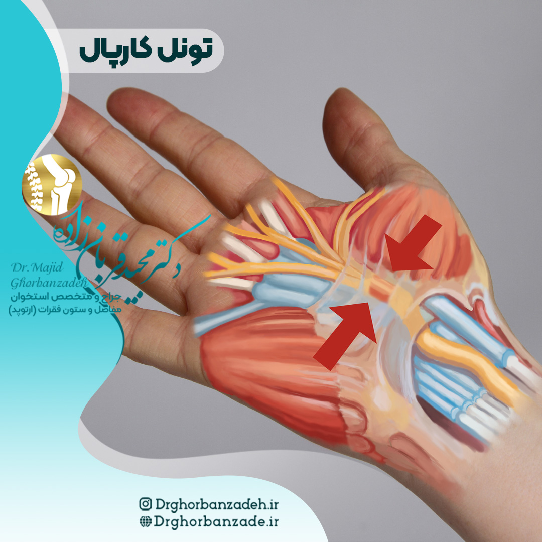 سندروم تونل کارپال(تنگی کانال مچ دست)