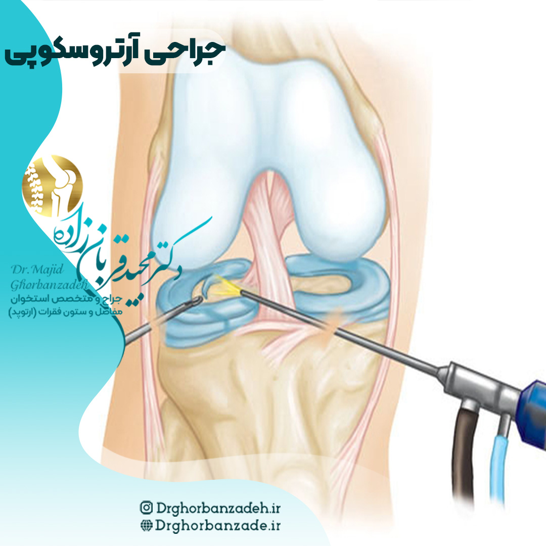 عمل جراحی آرتروسکوپی چیست؟