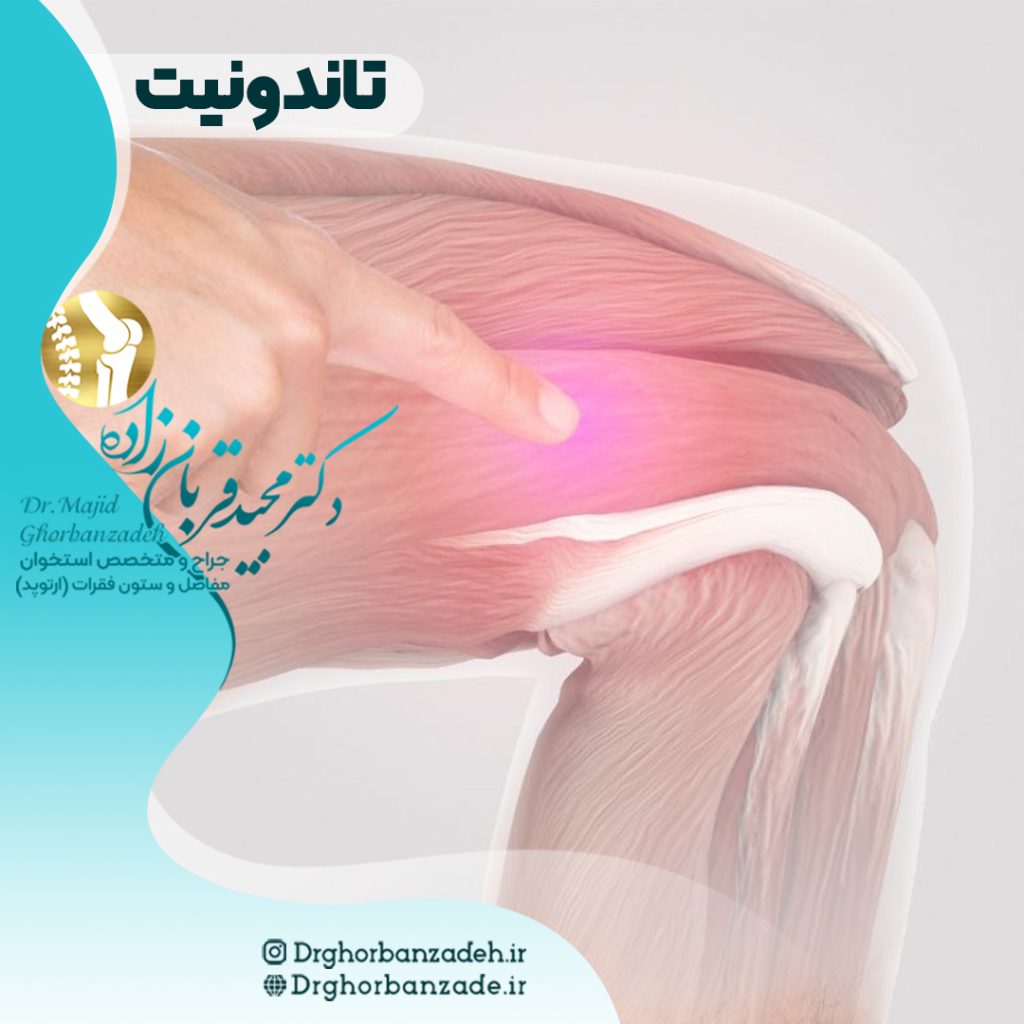 انواع تاندونیت( التهاب تاندون)