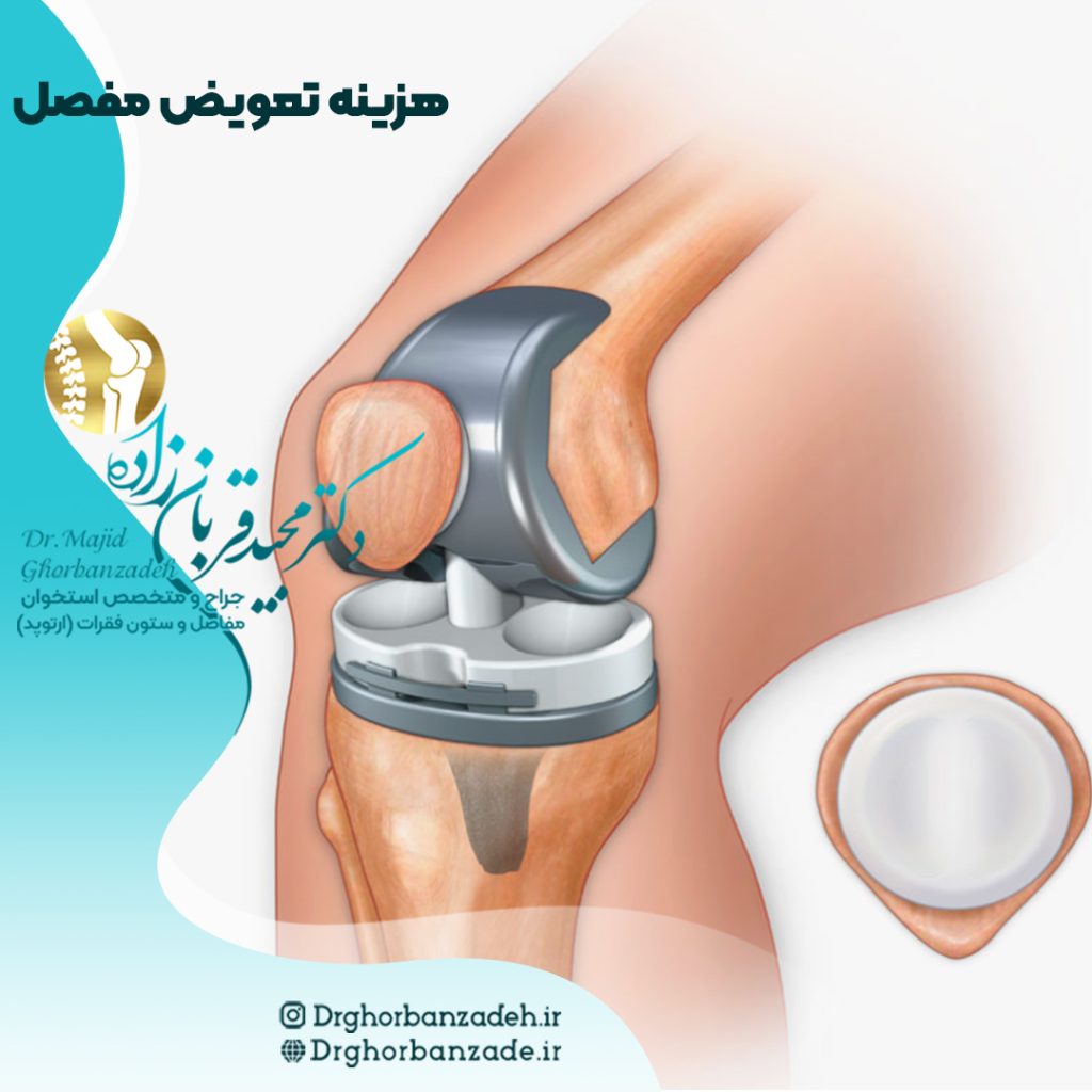 هزینه تعویض مفصل زانو
