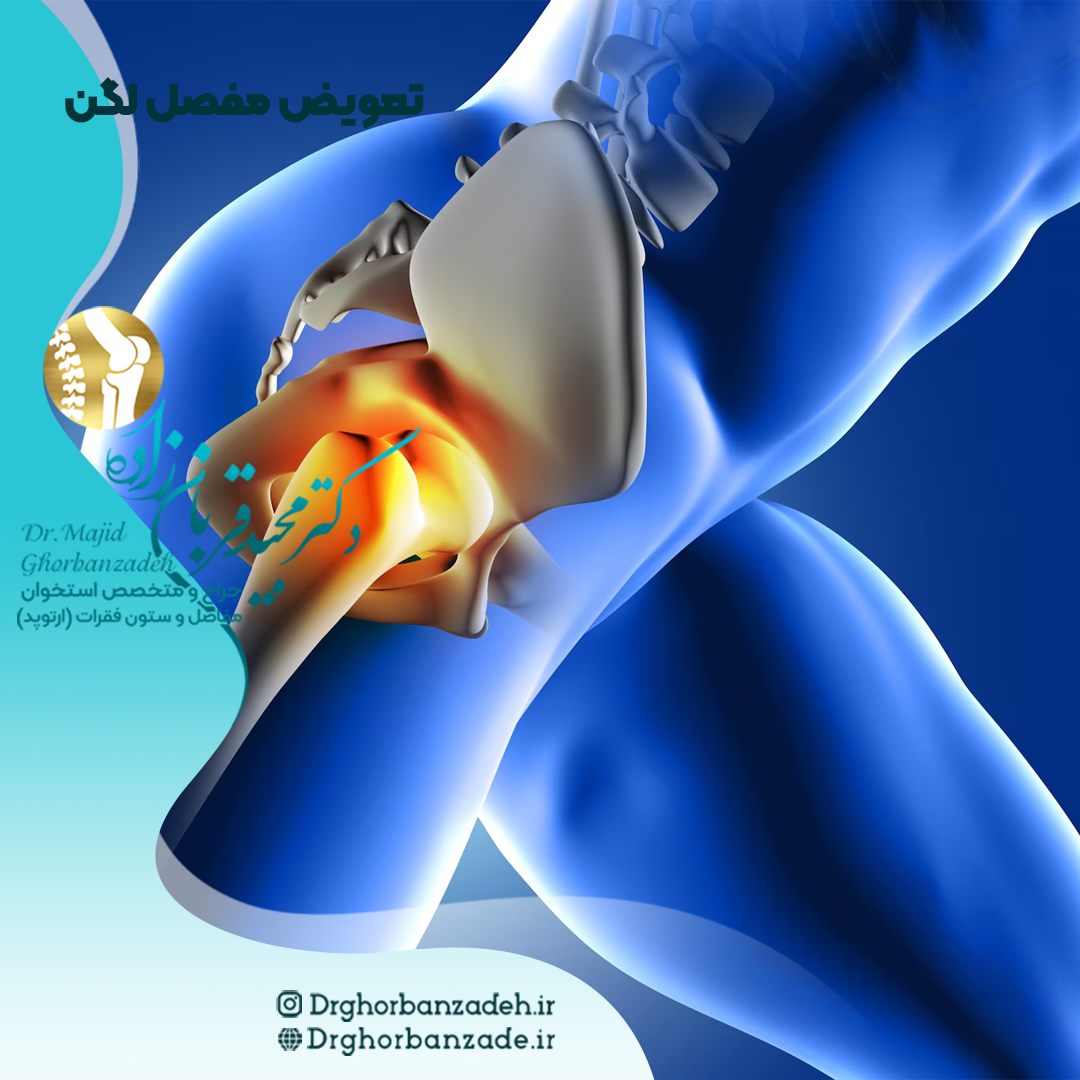 تعویض مفصل لگن